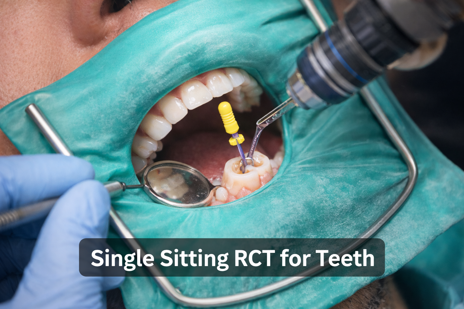 Single Sitting RCT